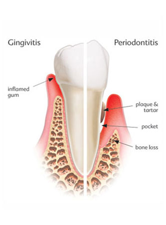 periodontal gum disease