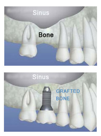 sinus augmentation